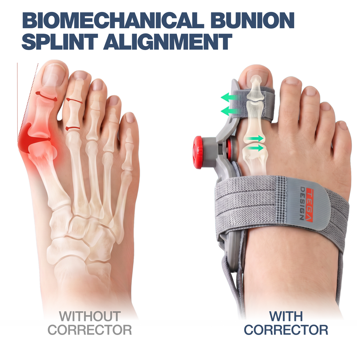 Do Bunion Correctors Actually Work?