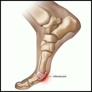 You Need to Know About Turf Toe Pain!